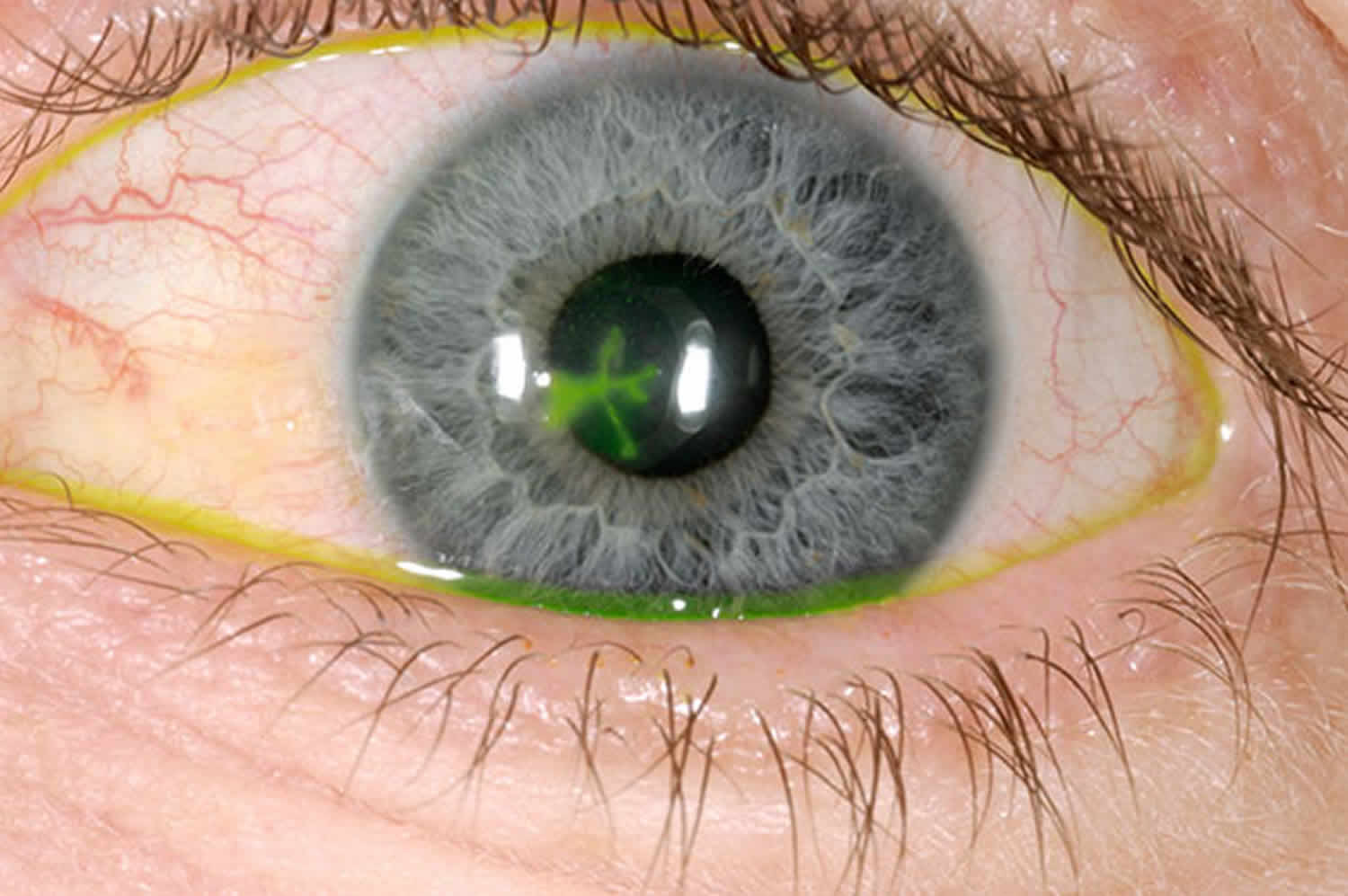 Corneal Ulcer And Marginal Corneal Ulcer Causes Symptoms Treatment