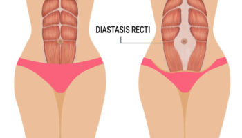 diastasis recti