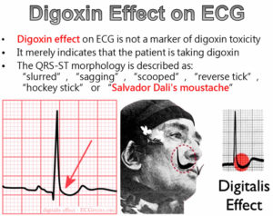 signs of digoxin toxicity on ecg