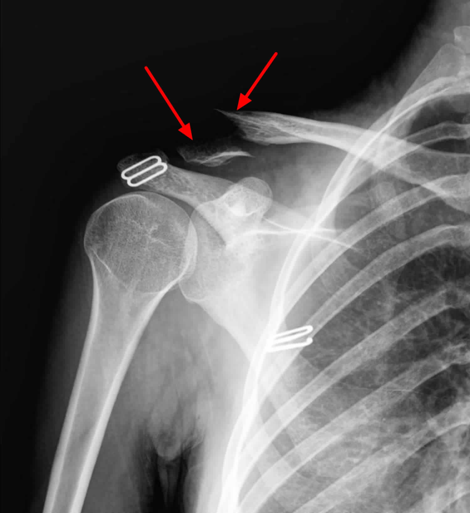 broken collarbone x ray