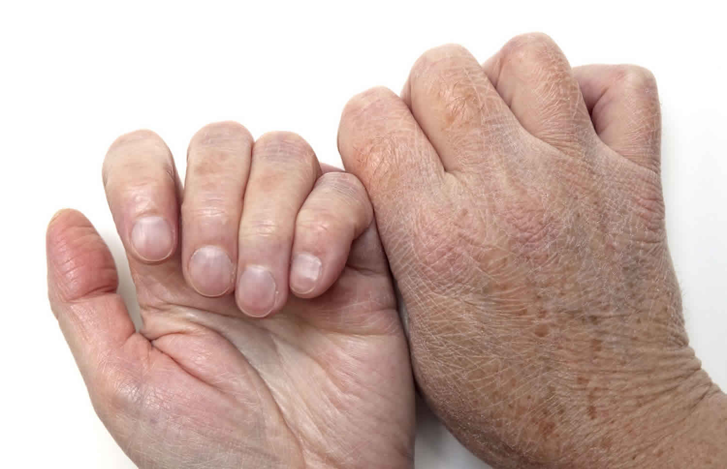 Dry Red Skin On Hands In Winter