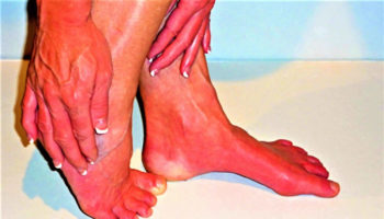 erythromelalgia