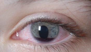 eye injury