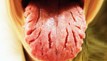 fissured tongue