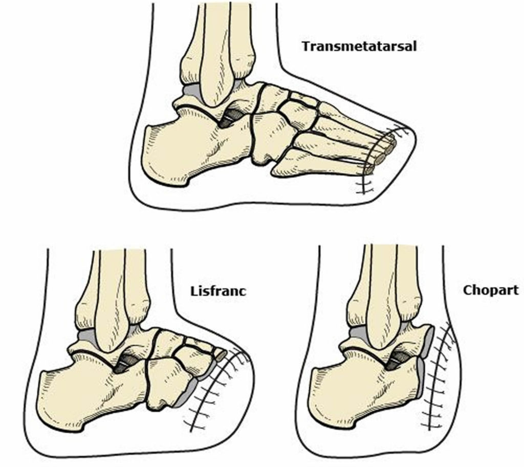 Amputation Causes, Types Of Amputation And Amputation Complications