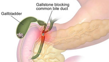 gallstones