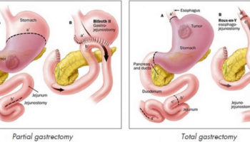 gastrectomy