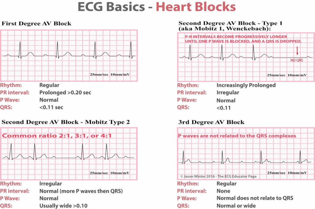 Heart block causes, symptoms, types, diagnosis and heart block treatment