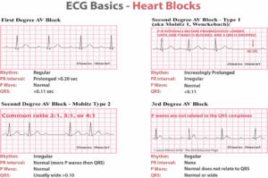 Heart block causes, symptoms, types, diagnosis and heart block treatment