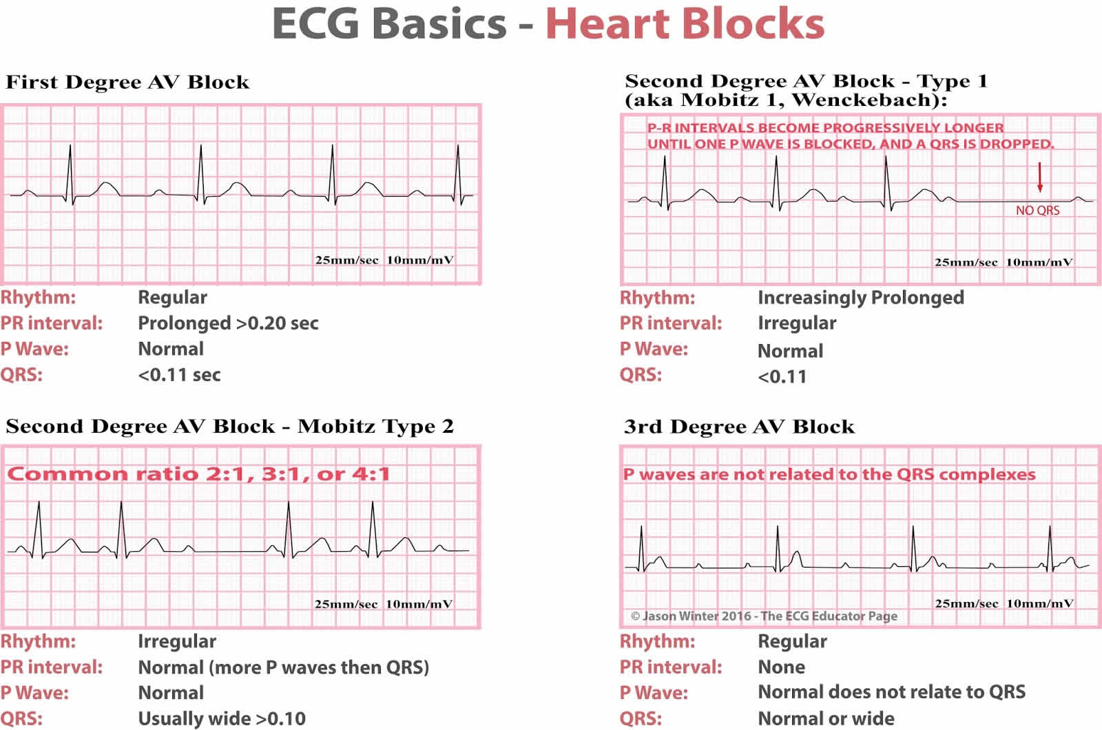 presentation of heart blocks