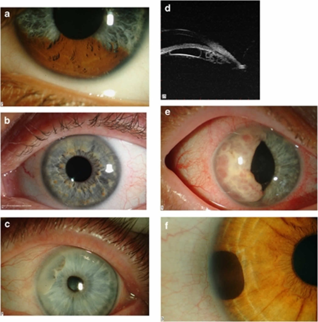 Heterochromia eyes in humans causes, how rare is heterochromia iridis?