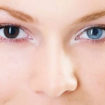 heterochromia eyes