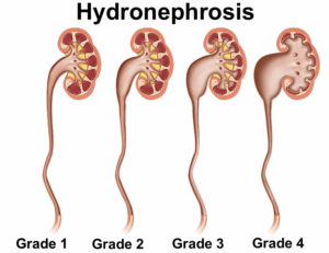 Hydronephrosis causes, symptoms, grading, diagnosis and treatment