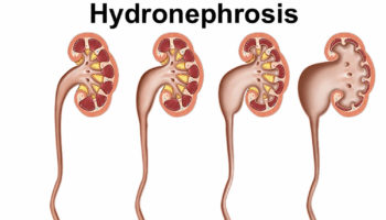 hydronephrosis