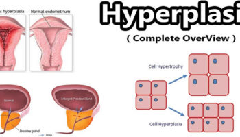 hyperplasia