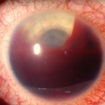 hyphema