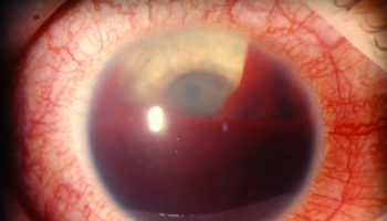 hyphema