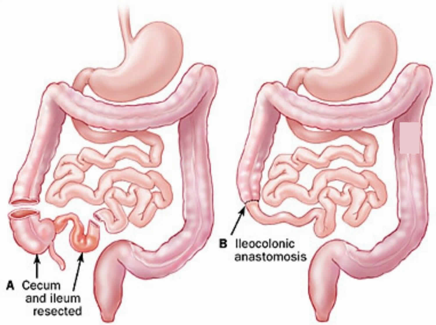 biliary-strictures-surgical-aspects-youtube