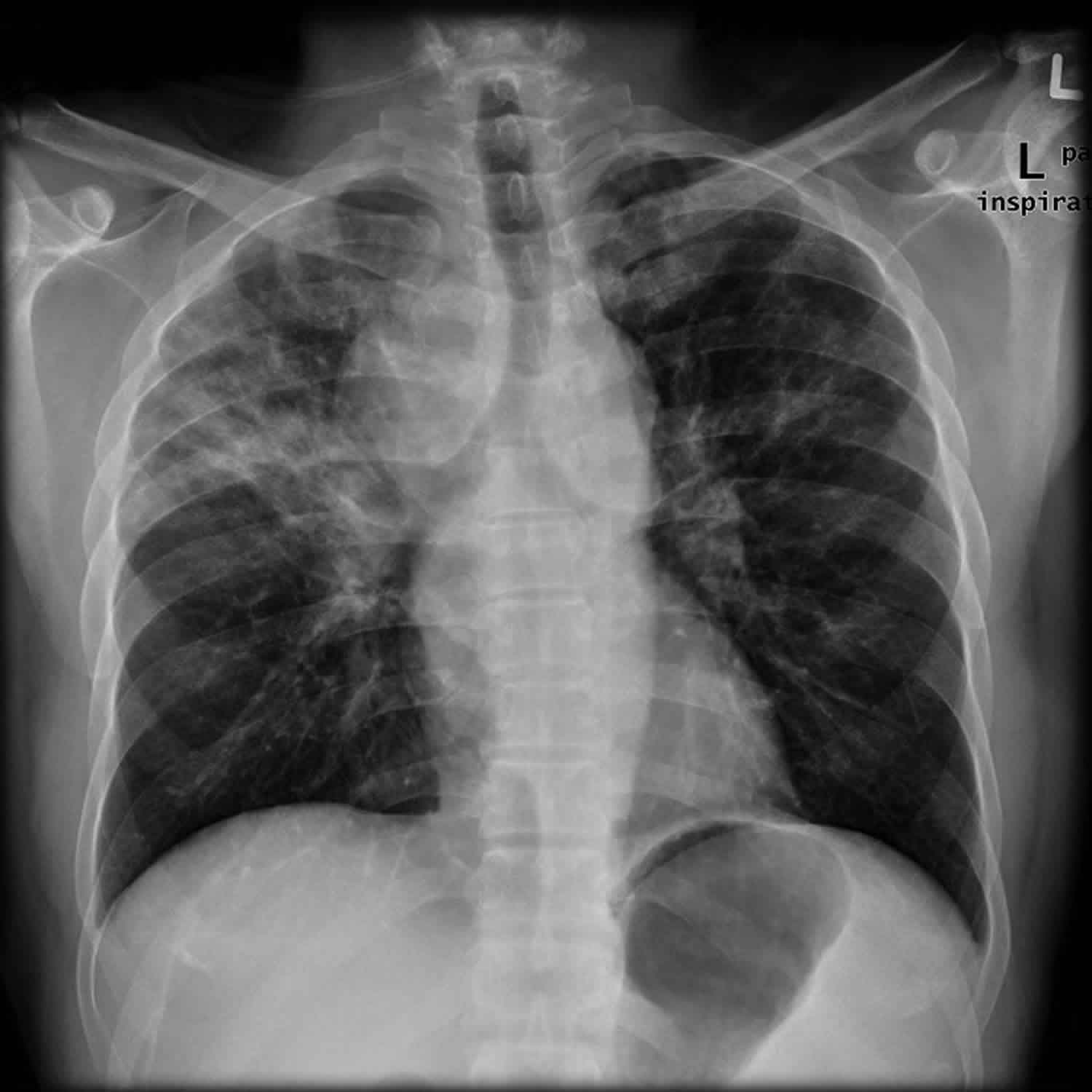 What Causes Chronic Interstitial Lung Disease