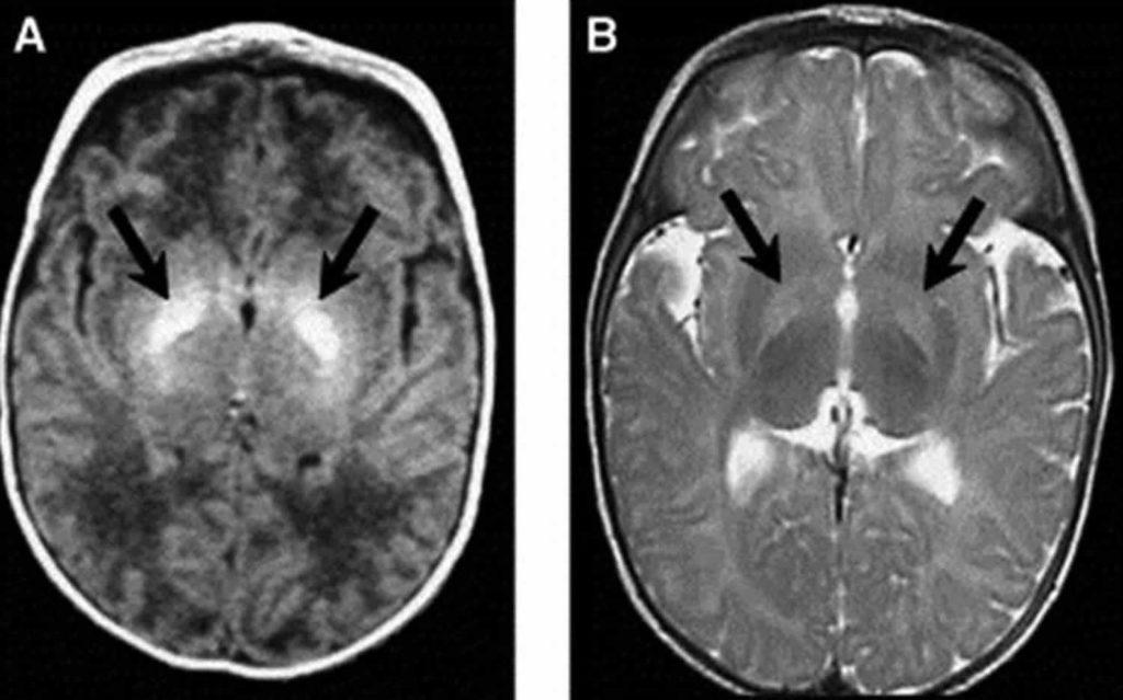 Kernicterus in newborn causes, signs, symptoms, diagnosis and treatment