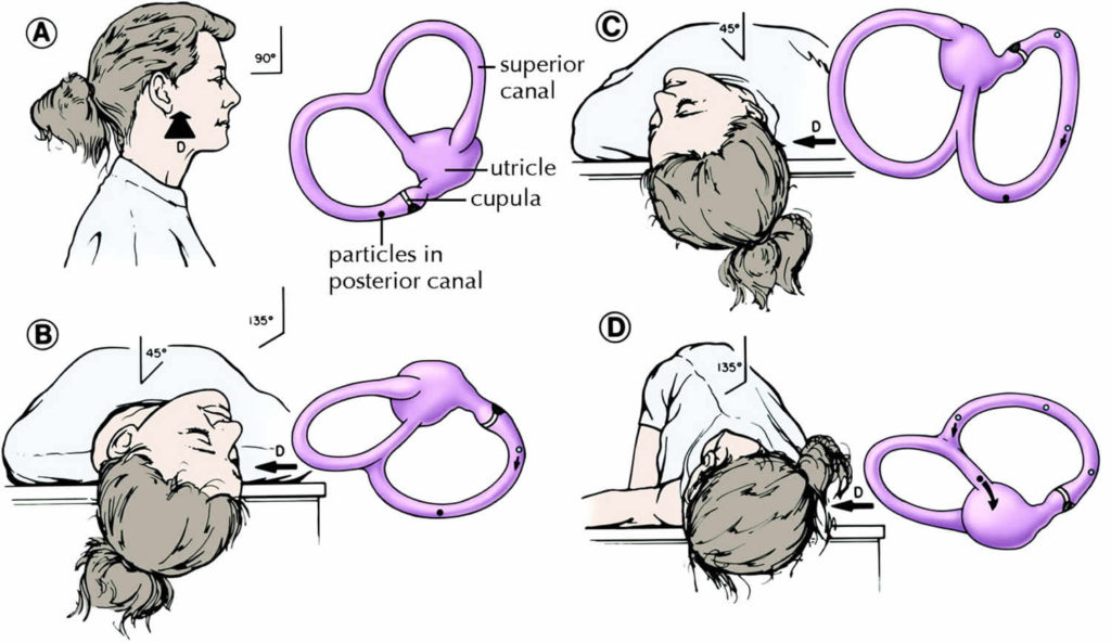 Epley Maneuver Instructions - How To Do The Epley Maneuver At Home