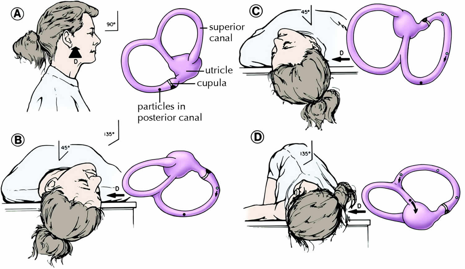 benign positional vertigo epley maneuver