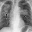 pneumoconiosis