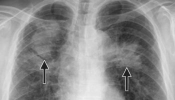 pneumoconiosis