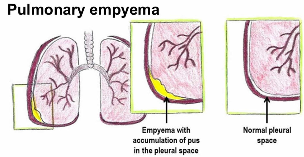 Empyema, lung empyema, causes, symptoms, diagnosis and treatment