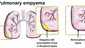 pulmonary-empyema