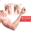 rotator cuff injury