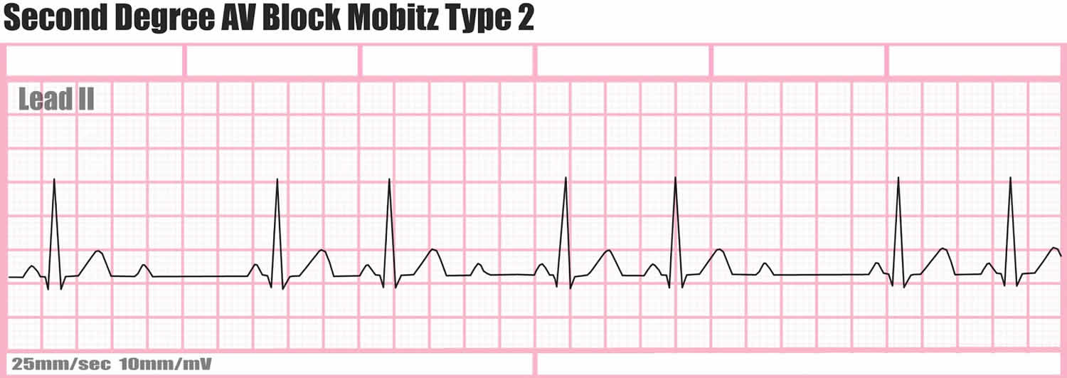 Heart Block Causes Symptoms Types Diagnosis And Heart Block Treatment