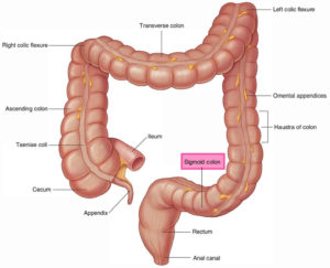 Sigmoid colon anatomy, location, function, polyps, diverticulosis & cancer