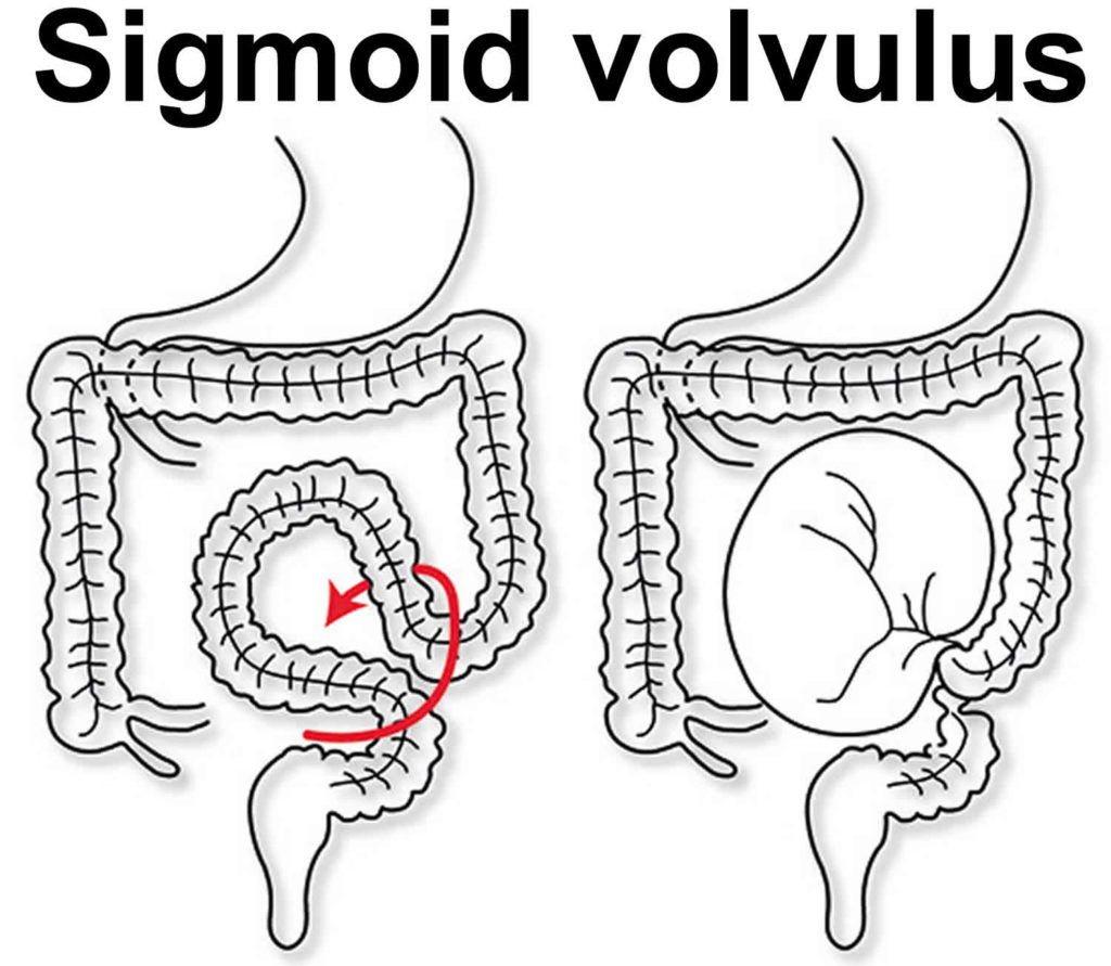 Sigmoid colon anatomy, location, function, polyps, diverticulosis & cancer
