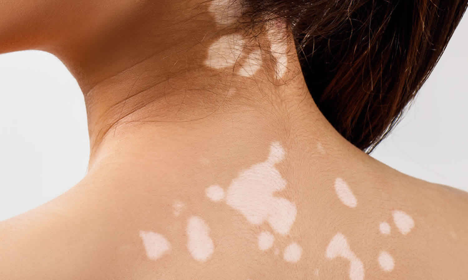 Skin discoloration causes and dark or white skin discoloration treatment