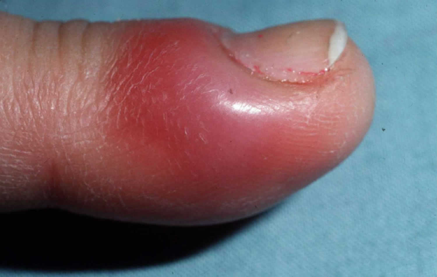 Chronic Paronychia: A Rundown Of The Fingernail Infection - Angeline Yong  Dermatology