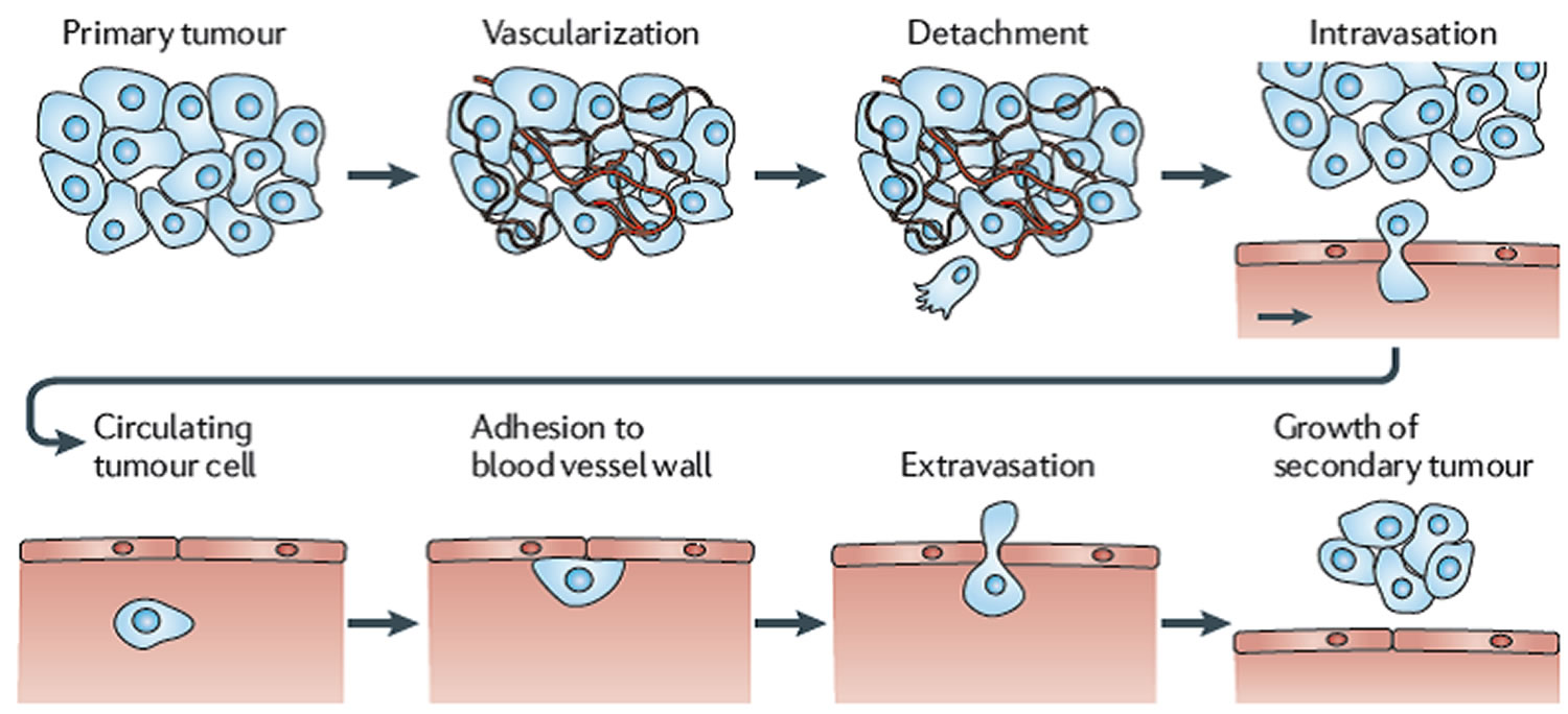 frontiers-innovative-options-for-bone-metastasis-treatment-an