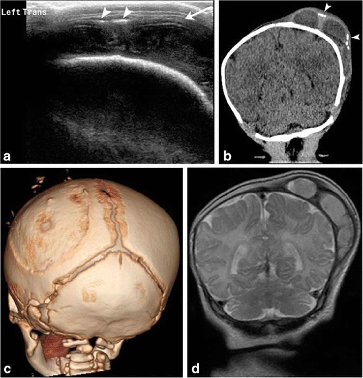 Cephalohematoma Ultrasound