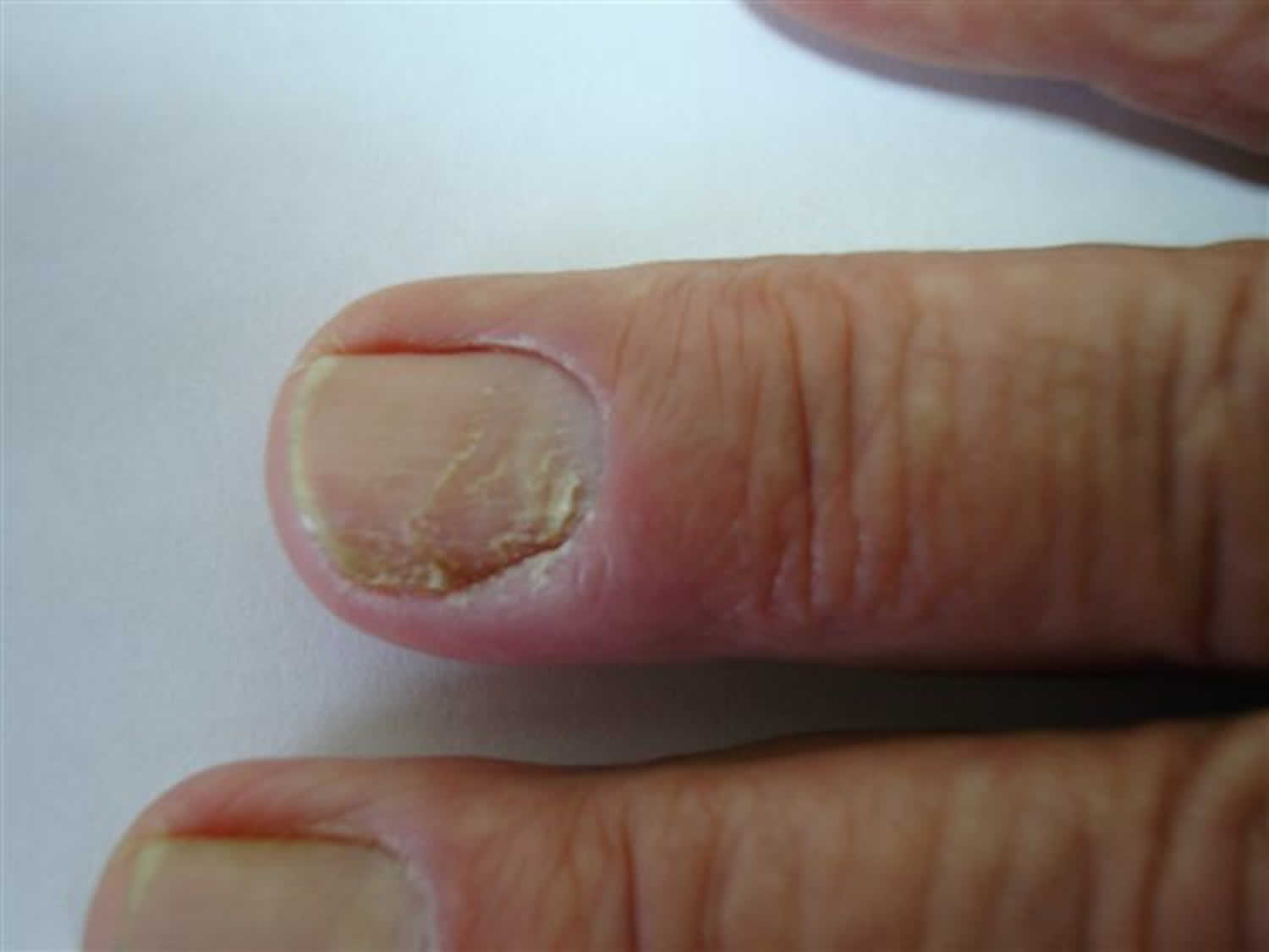 7 Reasons Why Fingernail Hurts When Pressed | Blossom Nail Spa