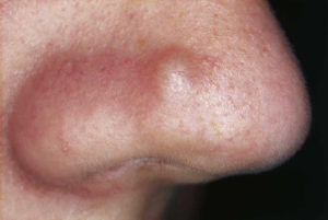 Papule or fibrous papules on nose causes, diagnosis & papule treatment