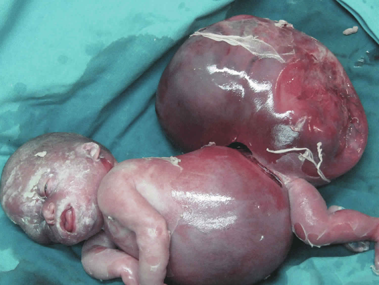 Hydrops fetalis baby with sacrococcygeal teratoma