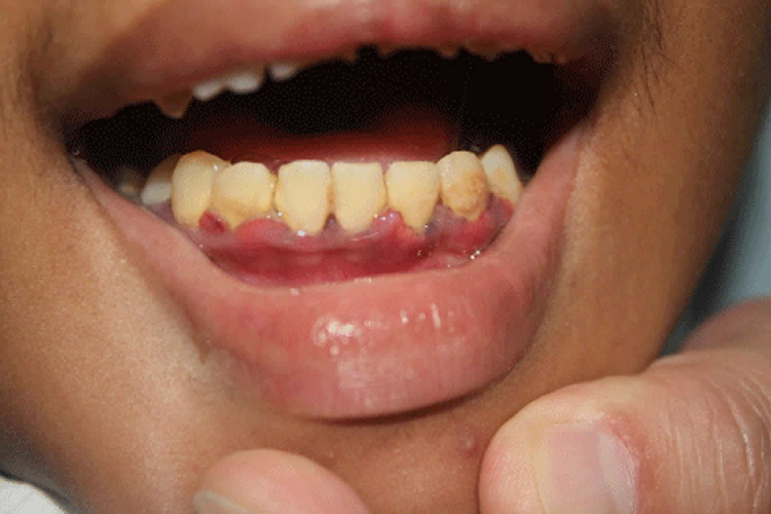 inflamed marginal gingiva in scurvy