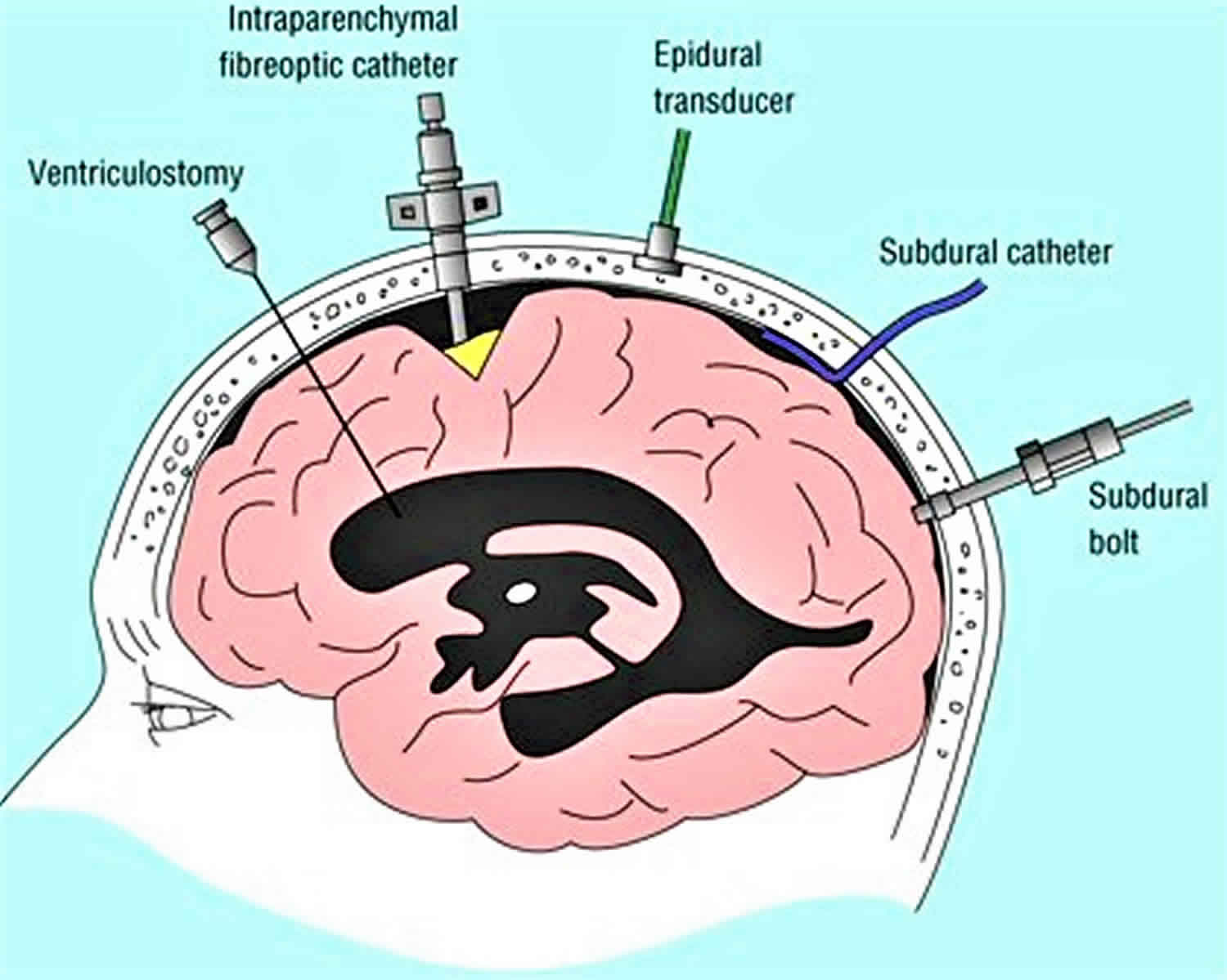 Simple Info About How To Check Intracranial Pressure - Dancelocation19