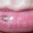 Labial melanotic macule