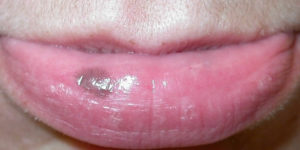 Labial Melanotic Macule Or Oral Melanotic Macule Causes And Treatment   Labial Melanotic Macule 300x150 