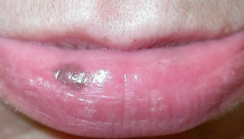 Labial melanotic macule