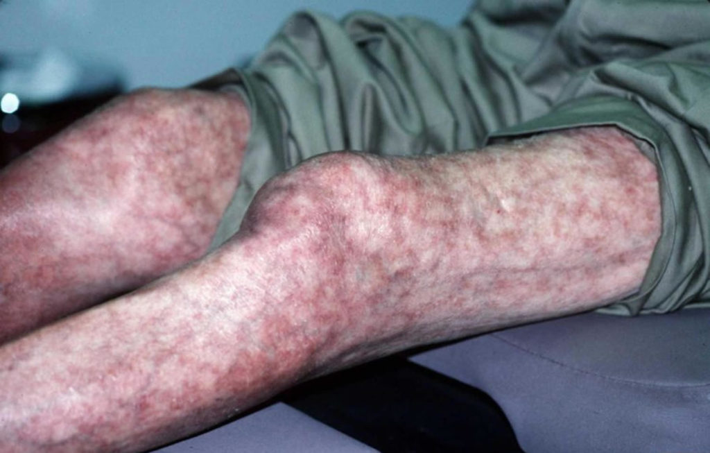 Mottled Skin Or Livedo Reticularis Causes Diagnosis And Treatment 3040