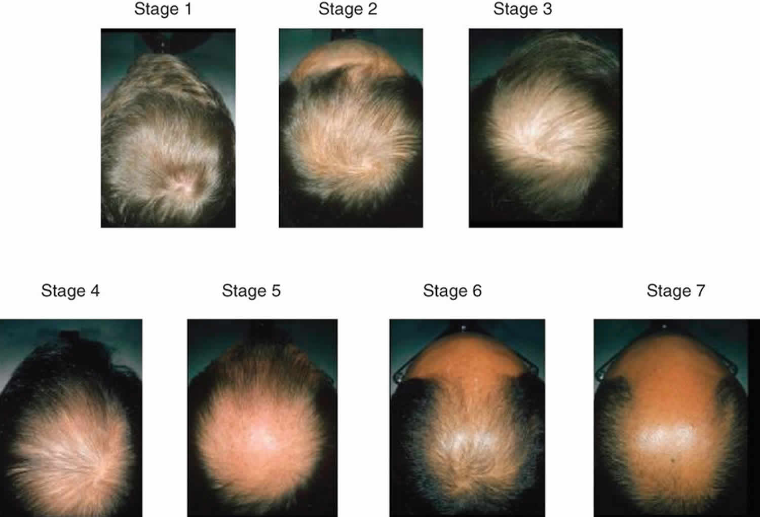 Male Pattern Baldness Stages 