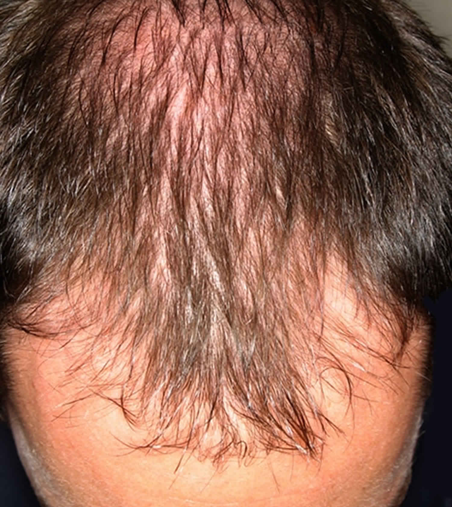 Волосы выпадают короткими. Андрогенная алопеция миноксидил. Очаговая алопеция (alopecia Areata).