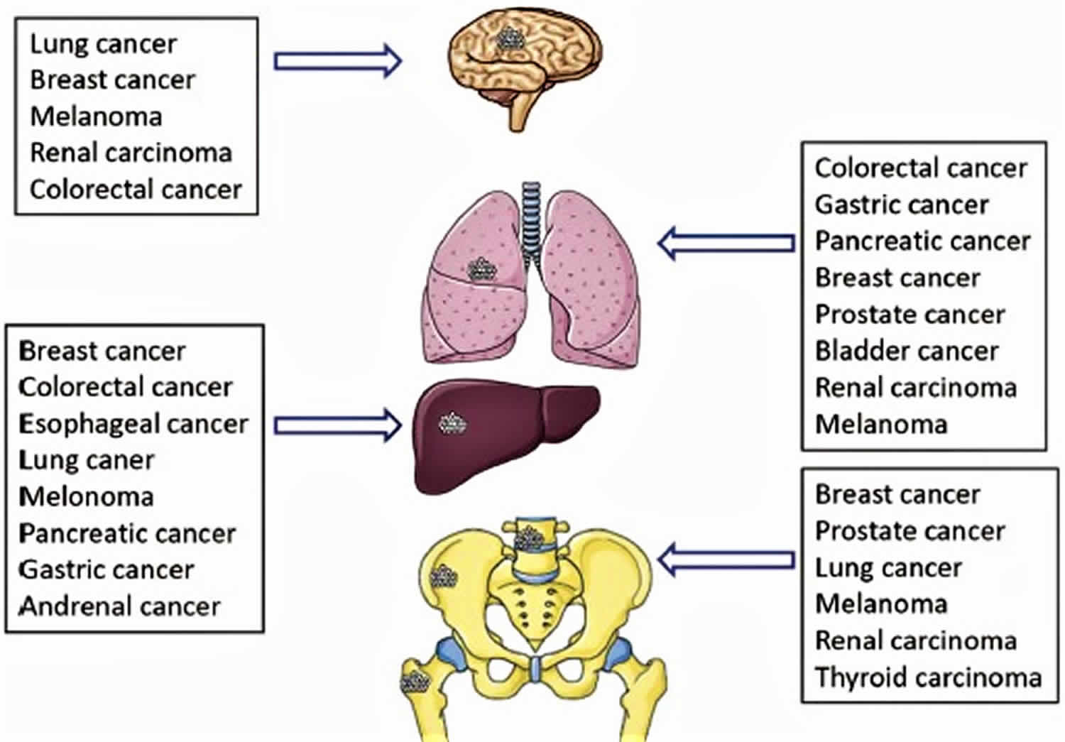 what is the survival rate of lung cancer that has spread to the brain ...